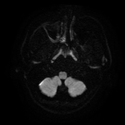 File:Cerebral cavernous venous malformation (Zabramski type II) (Radiopaedia 85511-101198 Axial DWI 38).jpg