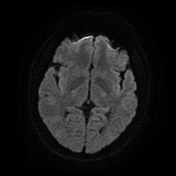 Cerebral cavernous venous malformation (Zabramski type II) (Radiopaedia 85511-101198 Axial DWI 49).jpg