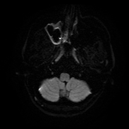 Cerebral cavernous venous malformation (Zabramski type II) (Radiopaedia 85511-101198 Axial DWI 6).jpg