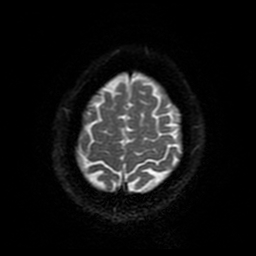Cerebral cavernous venous malformation (Zabramski type II) (Radiopaedia 85511-101198 Axial DWI 93).jpg