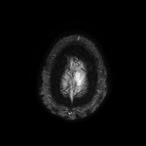 Cerebral cavernous venous malformation (Zabramski type II) (Radiopaedia 85511-101198 Axial SWI 110).jpg