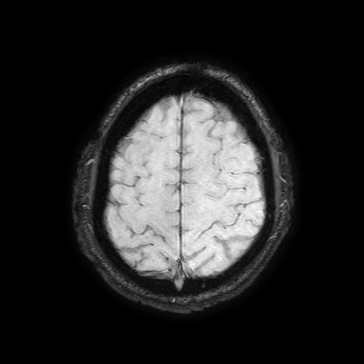 Cerebral cavernous venous malformation (Zabramski type II) (Radiopaedia 85511-101198 Axial SWI 97).jpg
