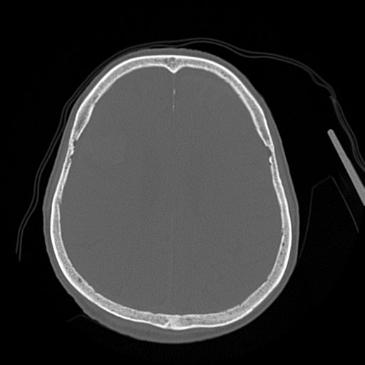 Cerebral contusions, subarachnoid hemorrhage and subdural hygromas (Radiopaedia 55399-61827 Axial bone window 35).png