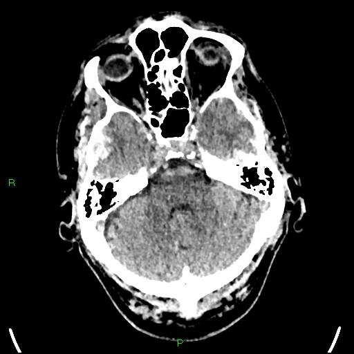 File:Cerebral contusions (Radiopaedia 33868-35039 Axial non-contrast 53).jpg