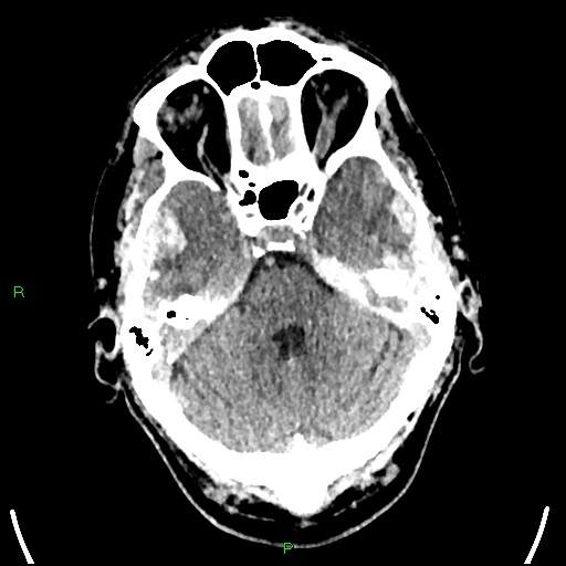 Cerebral contusions (Radiopaedia 33868-35039 Axial non-contrast 59).jpg