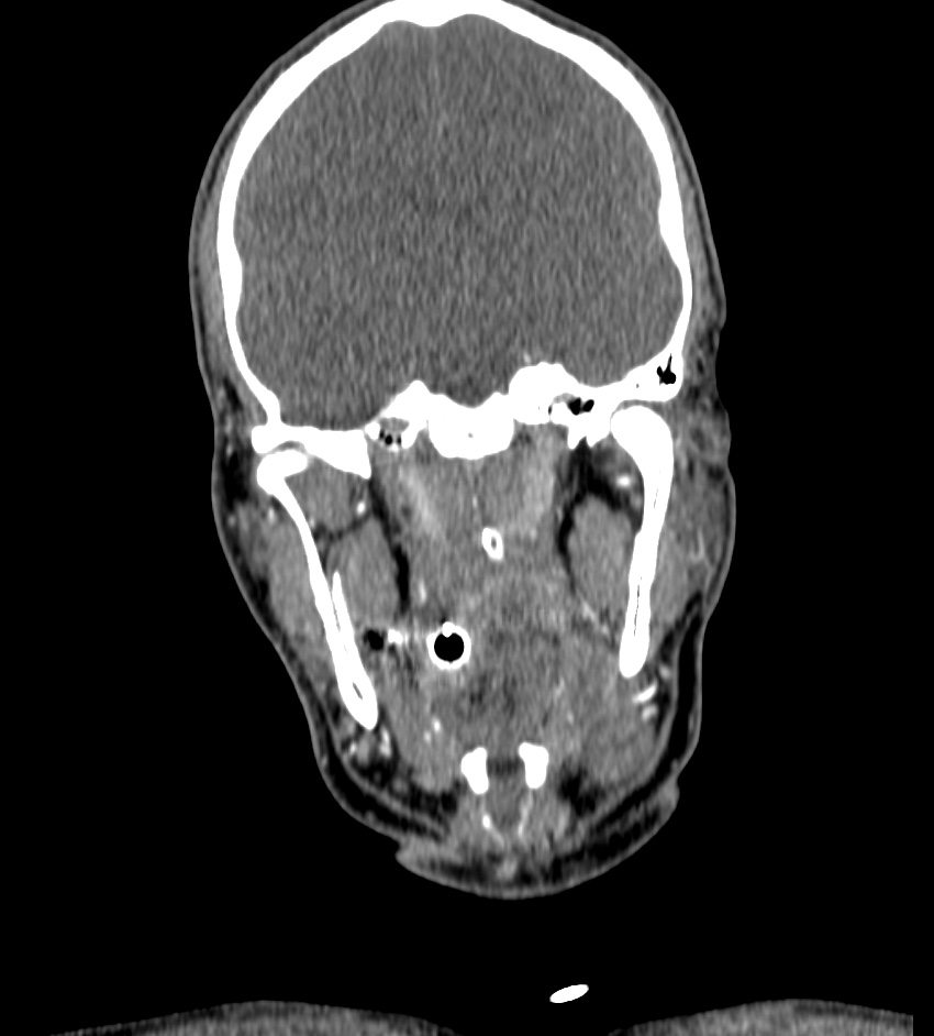 Cerebral edema in an overdose patient (Radiopaedia 72005-82539 B 41).jpg