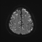 Cerebral embolic infarcts (embolic shower) (Radiopaedia 72391-82921 Axial DWI 53).jpg