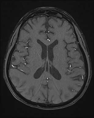 Cerebral embolic infarcts (embolic shower) (Radiopaedia 72391-82921 Axial MRA 112).jpg
