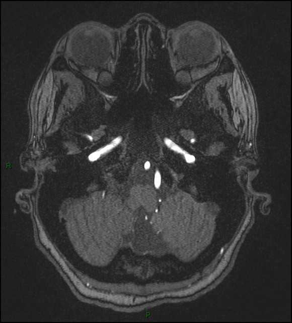 Cerebral fat embolism (Radiopaedia 35022-36525 Axial TOF 30).jpg