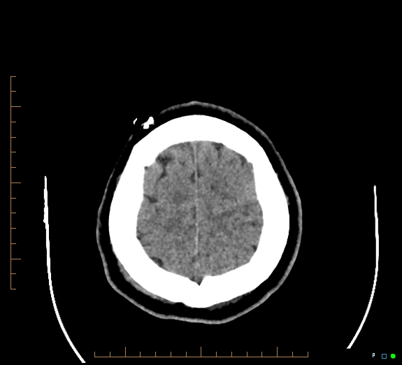Cerebral fat embolism (Radiopaedia 85521-101220 Axial non-contrast 52).jpg