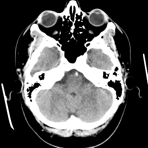 Cerebral hemorrhage secondary to arteriovenous malformation (Radiopaedia 33497-34561 B 13).png