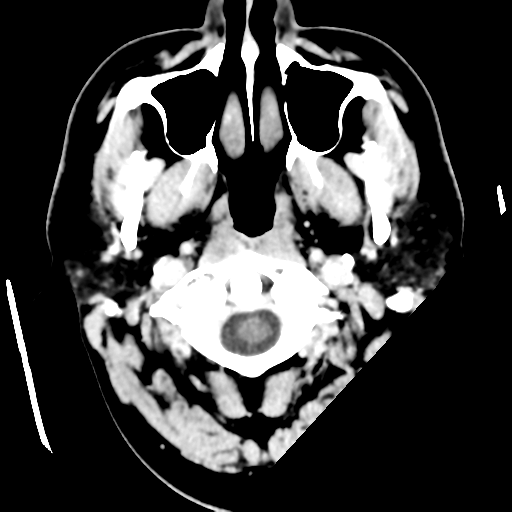 Cerebral hemorrhage secondary to arteriovenous malformation (Radiopaedia 33497-34561 B 3).png