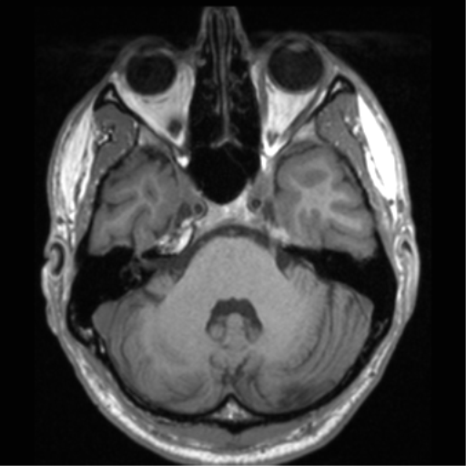 File:Cerebral hemorrhagic contusions- temporal evolution (Radiopaedia 40224-42757 Axial T1 21).png