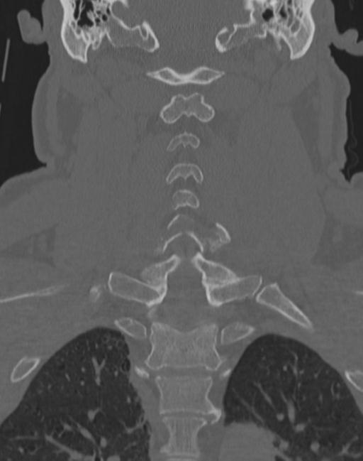 Cerebral hemorrhagic contusions and cervical spine fractures (Radiopaedia 32865-33841 Coronal bone window 43).jpg