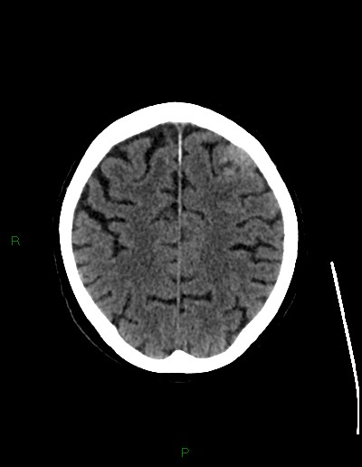 Cerebral metastases - ependymal and parenchymal (Radiopaedia 79877-93131 Axial non-contrast 59).jpg