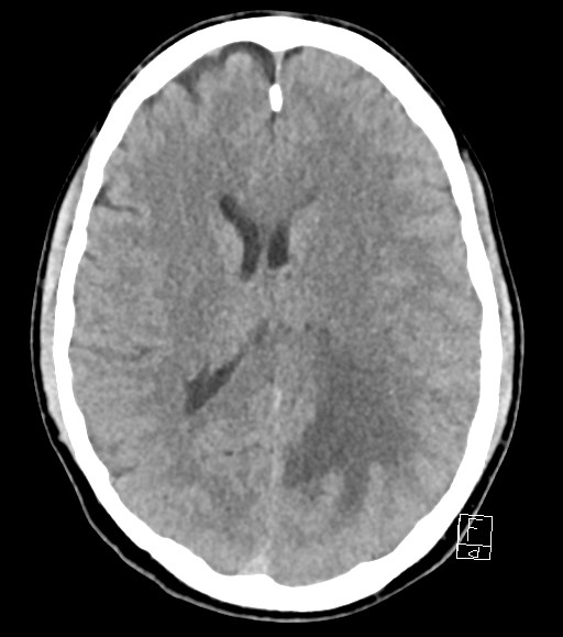 Cerebral metastases - testicular choriocarcinoma (Radiopaedia 84486-99855 Axial non-contrast 26).jpg