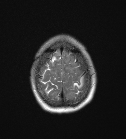 File:Cerebral metastasis (Radiopaedia 46744-51248 Axial T2 25).png