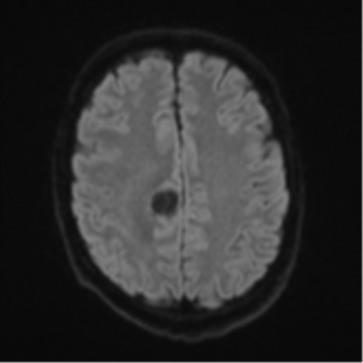 Cerebral metastasis - colorectal adenocarcinoma (Radiopaedia 50394-55765 Axial DWI 47).png