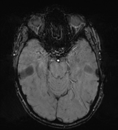 Cerebral metastasis - melanoma (Radiopaedia 54718-60954 Axial SWI 20).png