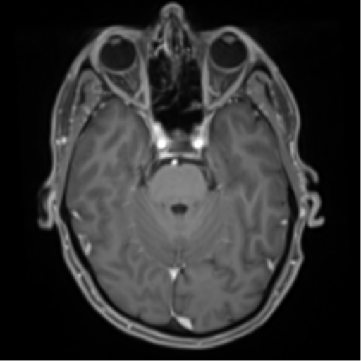 File:Cerebral metastasis - melanoma (Radiopaedia 54718-60954 Axial T1 C+ fat sat 18).png