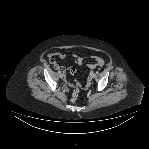 Cerebral metastasis from renal cell carcinoma (Radiopaedia 82306-96378 A 160).jpg
