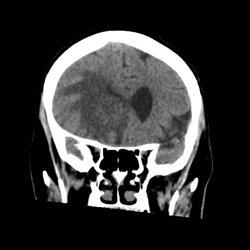 Cerebral metastasis to basal ganglia (Radiopaedia 81568-95412 Coronal non-contrast 25).png