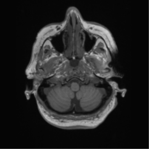 Cerebral metastasis to basal ganglia (Radiopaedia 81568-95413 Axial T1 8).png