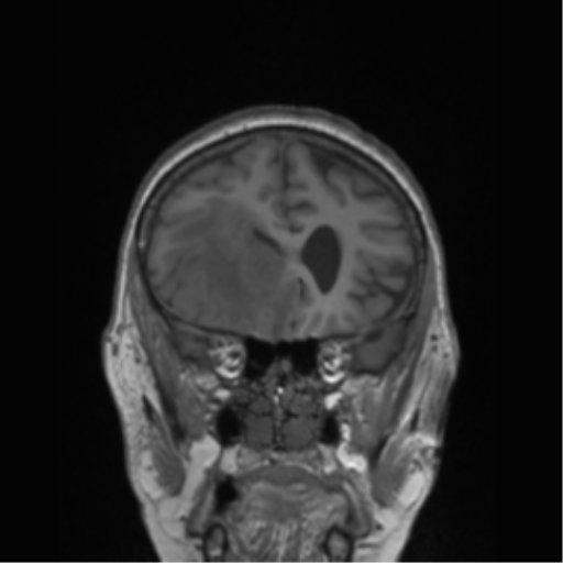 File:Cerebral metastasis to basal ganglia (Radiopaedia 81568-95413 Coronal T1 45).png