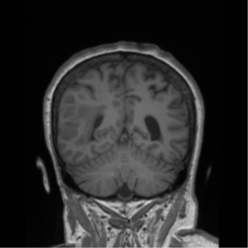 File:Cerebral metastasis to basal ganglia (Radiopaedia 81568-95413 Coronal T1 7).png