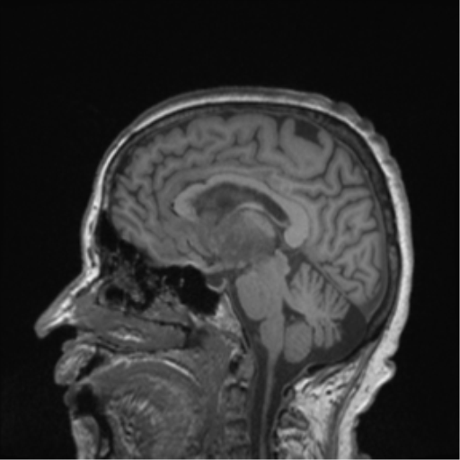 Cerebral metastasis to basal ganglia (Radiopaedia 81568-95413 Sagittal T1 34).png