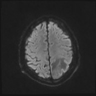 File:Cerebral toxoplasmosis (Radiopaedia 43956-47461 Axial DWI 17).jpg