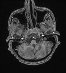 File:Cerebral toxoplasmosis (Radiopaedia 43956-47461 Axial T1 11).jpg