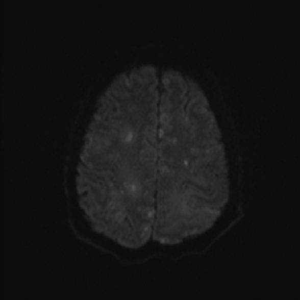 Cerebral toxoplasmosis (Radiopaedia 53993-60132 Axial DWI 48).jpg