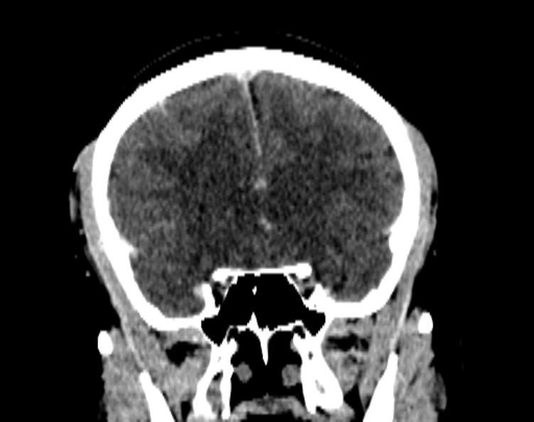 Cerebral venous hemorrhagic infarct from venous sinus thrombosis (Radiopaedia 55433-61883 Coronal C+ delayed 25).jpg