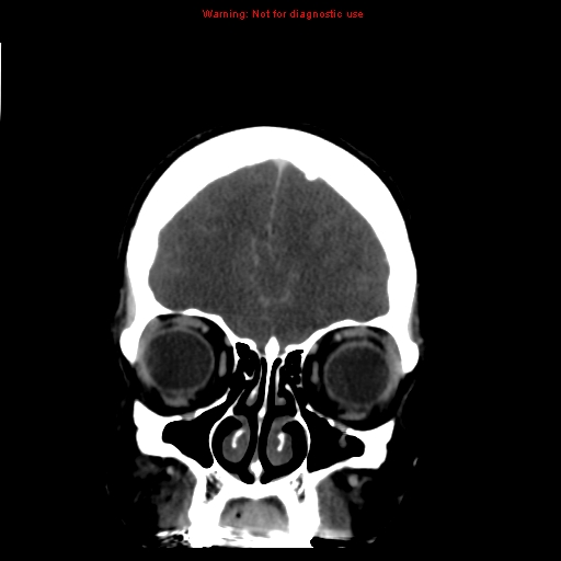 Cerebral venous infarction (Radiopaedia 12404-20735 B 14).jpg