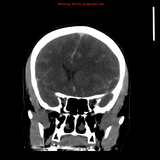 Cerebral venous infarction (Radiopaedia 12404-20735 B 27).jpg