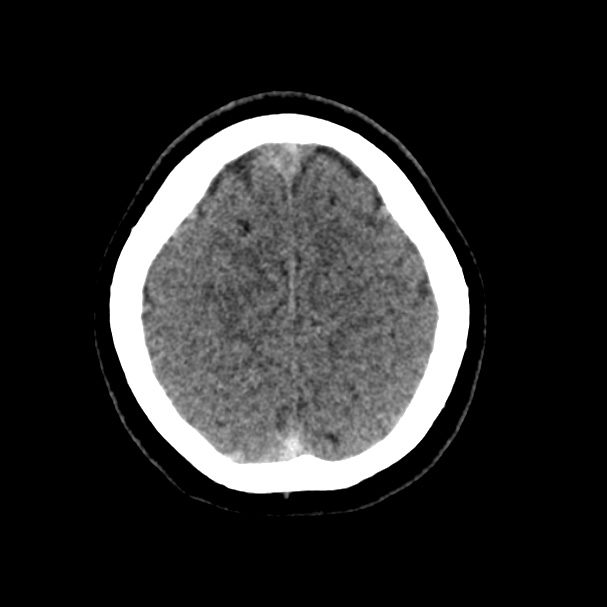 Cerebral venous sinus thrombosis (Radiopaedia 59224-66551 Axial non-contrast 41).jpg