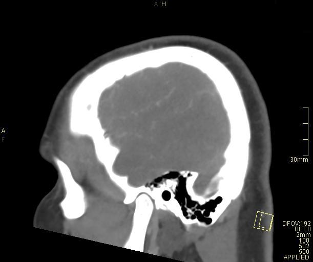 Cerebral venous sinus thrombosis (Radiopaedia 91329-108965 Sagittal venogram 65).jpg