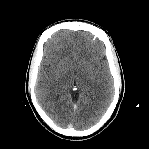 File:Cerebral venous thrombosis (CVT) (Radiopaedia 77524-89685 Axial non-contrast 23).jpg