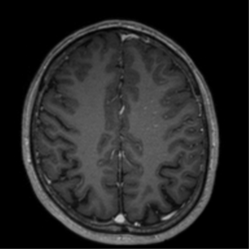 Cerebral venous thrombosis (Radiopaedia 38392-40469 Axial T1 C+ 56).png