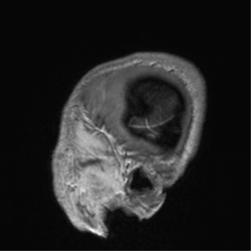 File:Cerebral venous thrombosis (Radiopaedia 38392-40469 Sagittal T1 C+ 11).png