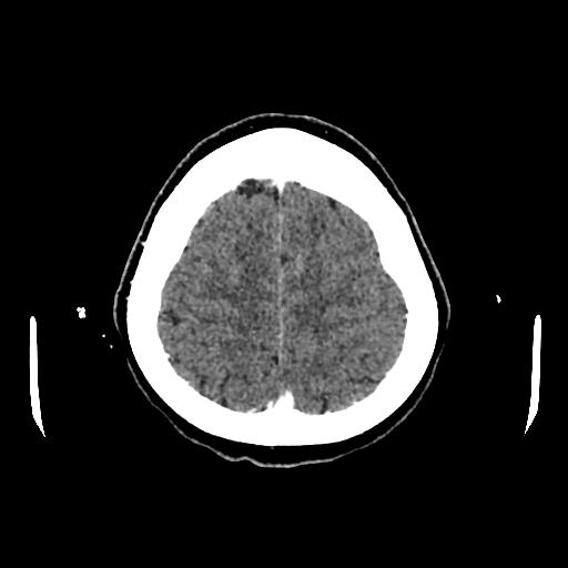 File:Cerebral venous thrombosis with venous hemorrhagic infarct (Radiopaedia 90354-107660 Axial with contrast 138).jpg