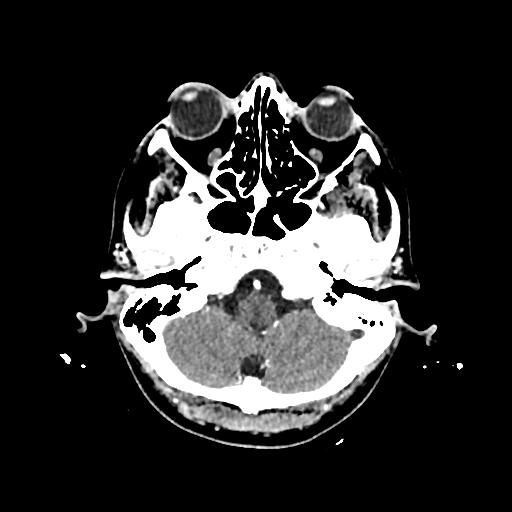 Cerebral venous thrombosis with venous hemorrhagic infarct (Radiopaedia 90354-107660 Axial with contrast 32).jpg