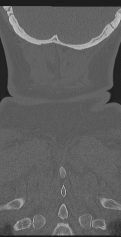 Cervical canal stenosis due to ossification of the posterior longitudinal ligament (Radiopaedia 47260-51823 Coronal bone window 65).png