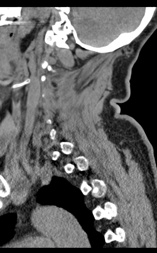Cervical canal stenosis due to ossification of the posterior longitudinal ligament (Radiopaedia 47260-51823 D 21).png