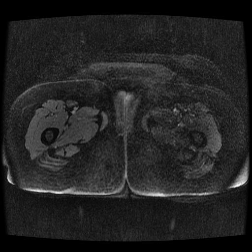 File:Cervical carcinoma (Radiopaedia 70924-81132 Axial T1 C+ fat sat 2).jpg