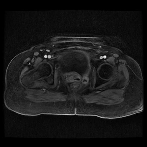 Cervical carcinoma (Radiopaedia 70924-81132 Axial T1 C+ fat sat 38).jpg