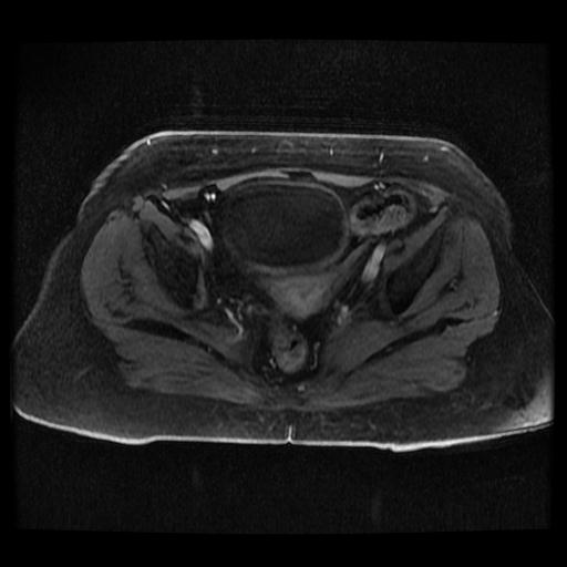 Cervical carcinoma (Radiopaedia 70924-81132 Axial T1 C+ fat sat 54).jpg