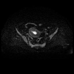 Cervical carcinoma (Radiopaedia 88010-104555 Axial DWI 35).jpg