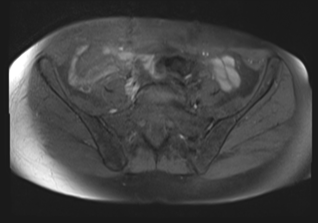 File:Cervical carcinoma (Radiopaedia 88312-104943 Axial T1 fat sat 5).jpg